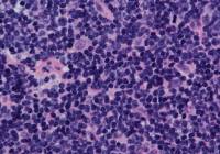 mantle cell lymphoma