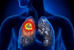 israel lung cancer detection