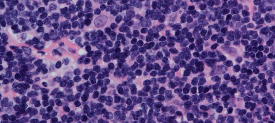 mantle cell lymphoma