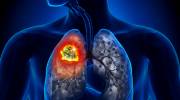 israel lung cancer detection