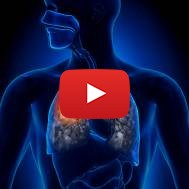 israel lung cancer detection