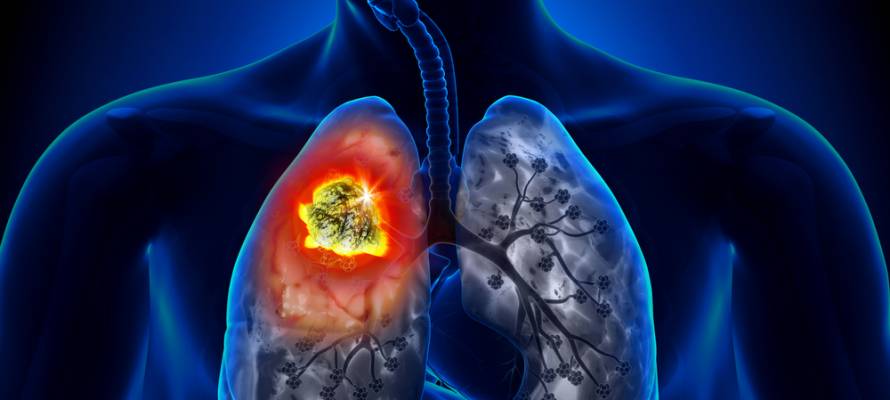 israel lung cancer detection