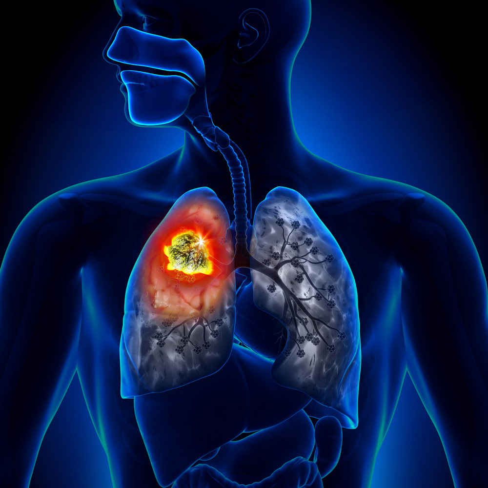 israel lung cancer detection