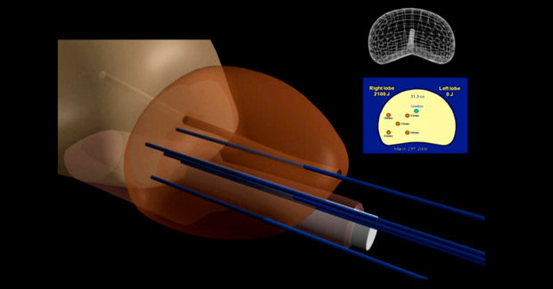 TOOKAD prostate cancer treatment