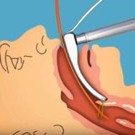 Israeli Doctor, Emergency Medic Invents Improved Intubation