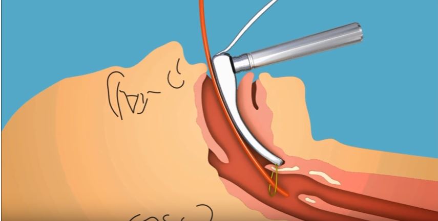 Israeli Doctor, Emergency Medic Invents Improved Intubation