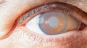 cornea implant