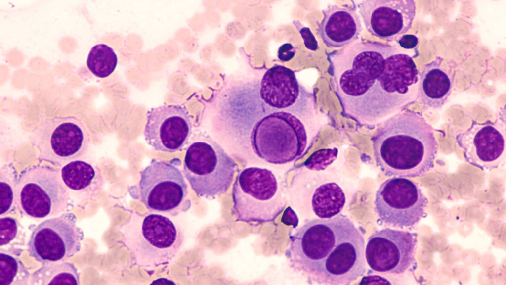 Melanoma Cancer Cells