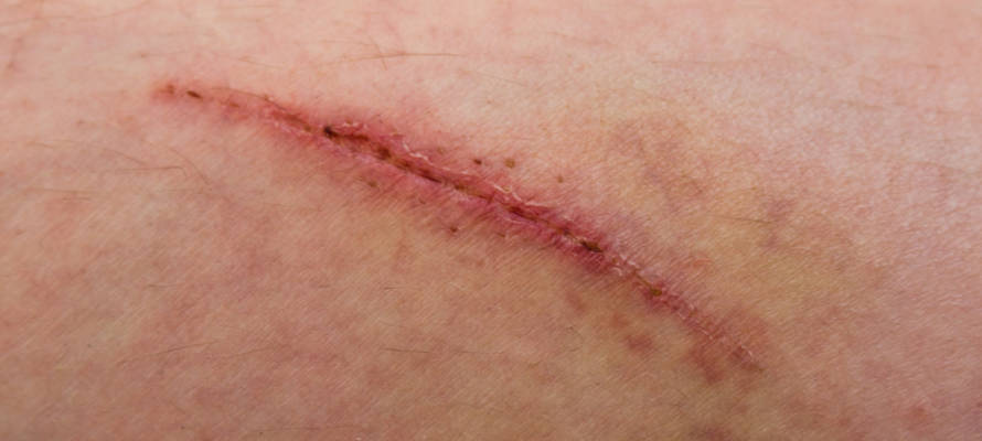 scarring surgery