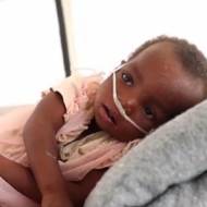 Child in Samoa suffering from measles epidemic.