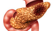 pancreatic cancer (Shutterstock)