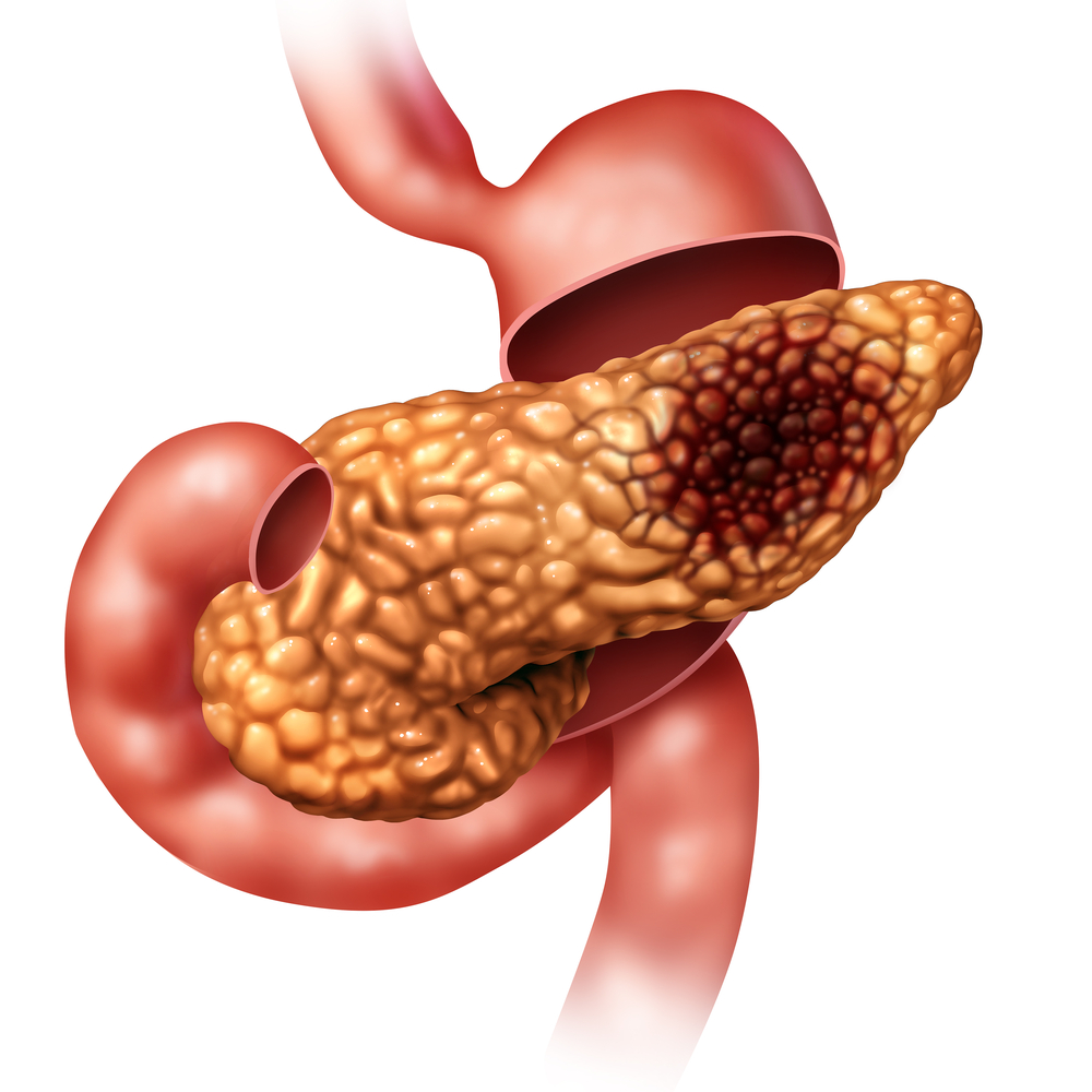 pancreatic cancer (Shutterstock)