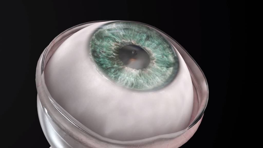 artificial cornea