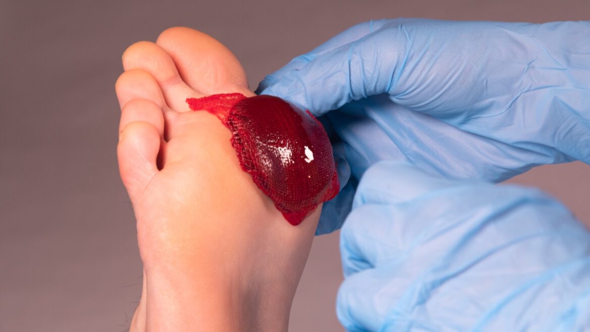 Israelis Invent Revolutionary Blood Clot That Heals Chronic Wounds - Vimarsana News
