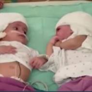 Twins conjoined at the head separated.v1