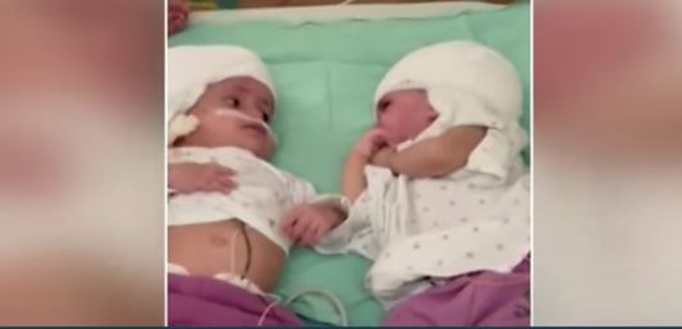 Twins conjoined at the head separated.v1